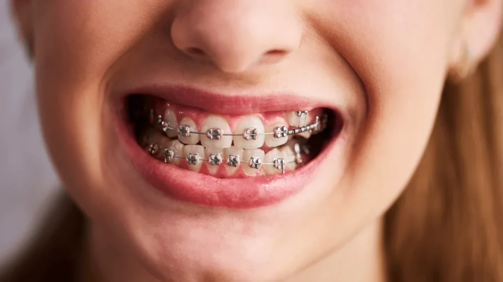 Invisalign Methuen MA | Clear Aligners at Happy Hoppers Dental